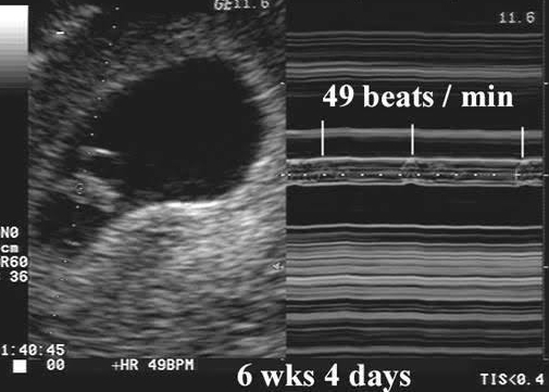 first trimester abnormal ultrasound.