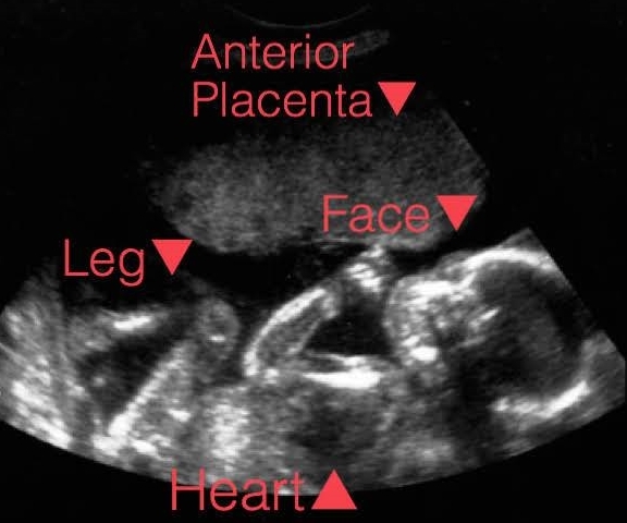 14 week ultrasound