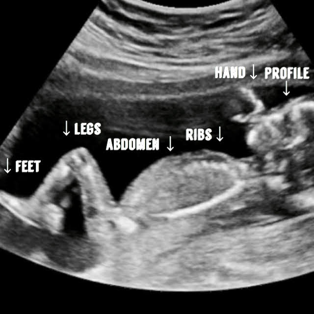 16 week ultrasound