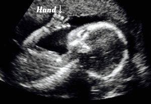 Normal 17 week baby Ultrasound.
