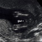 Normal 17 week baby Ultrasound.