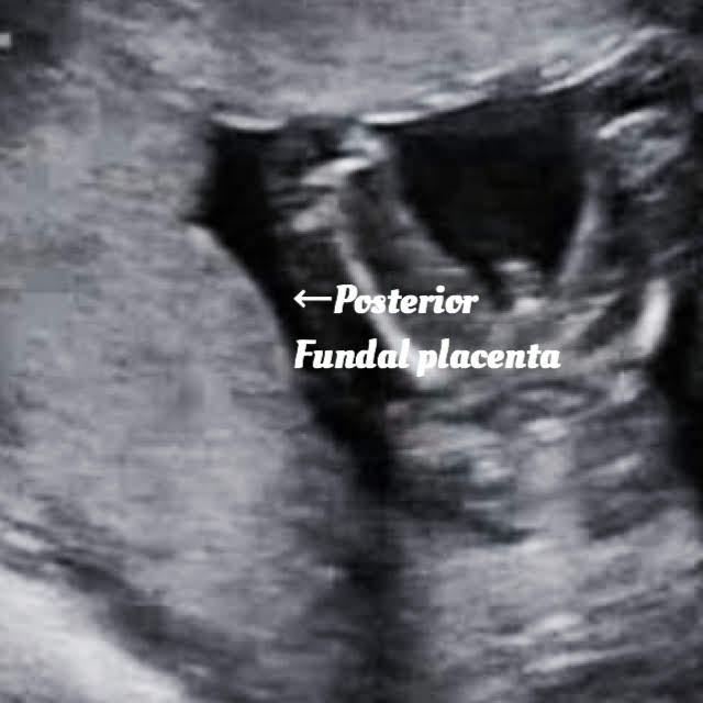 17 week baby ultrasound