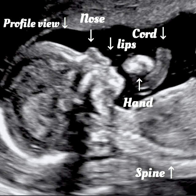 18 week ultrasound