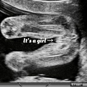 Normal 18 week baby ultrasound. - Ultrasoundfeminsider