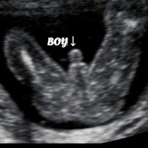 Normal 20 week baby ultrasound. - Ultrasoundfeminsider