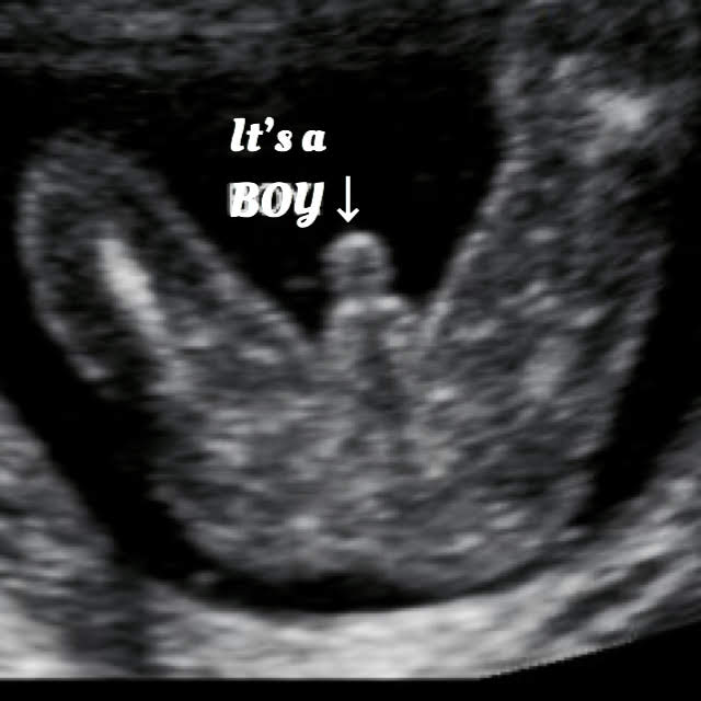 18 week ultrasound