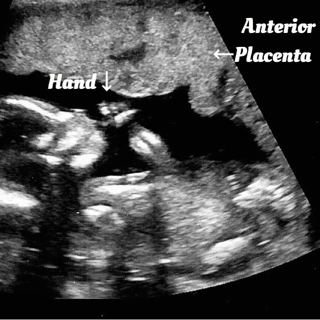 18 week ultrasound
