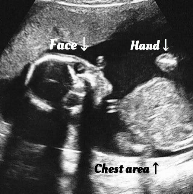 19 week Fetal pregnancy and ultrasound