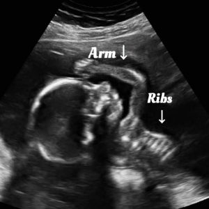 Normal 18 week baby ultrasound. - Ultrasoundfeminsider