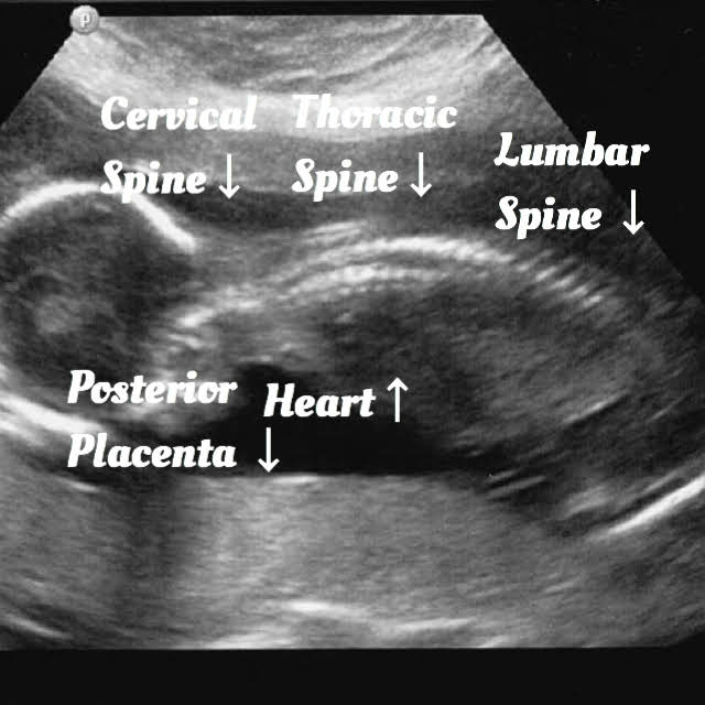 19 week Fetal pregnancy and ultrasound