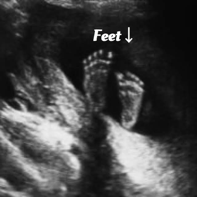 18 week ultrasound