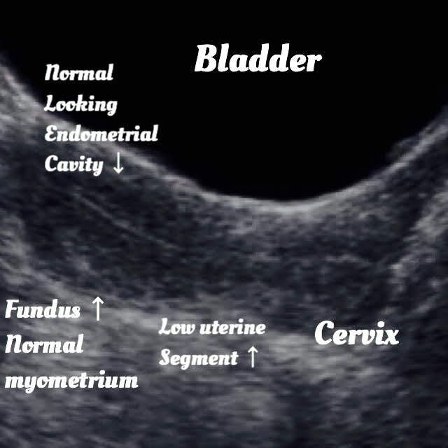 ultrasound of Adenomyosis