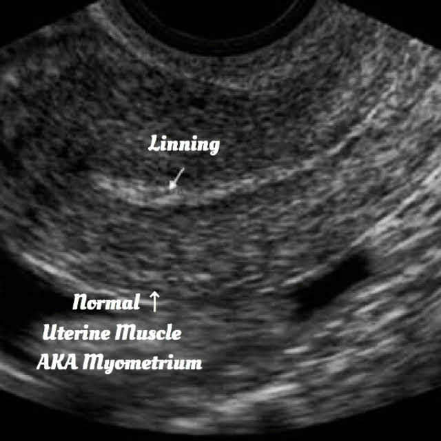 ultrasound of Adenomyosis