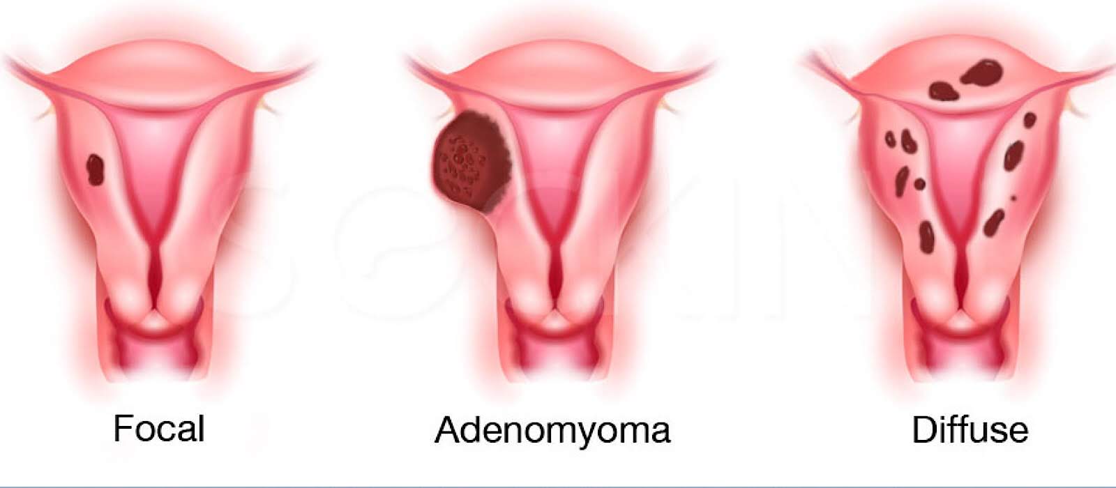 Adenomyosis