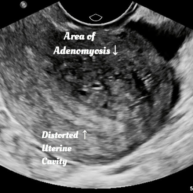 ultrasound of Adenomyosis