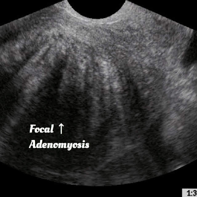ultrasound of Adenomyosis