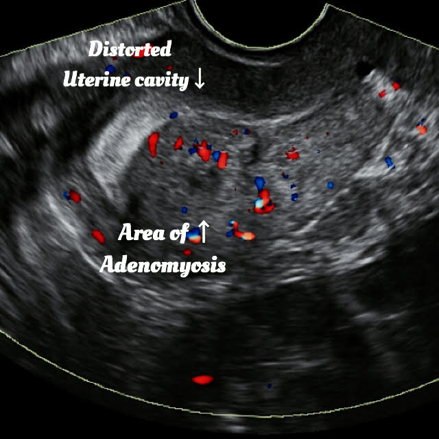 ultrasound image of Adenomyosis