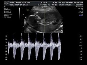 19 week Fetal pregnancy and ultrasound