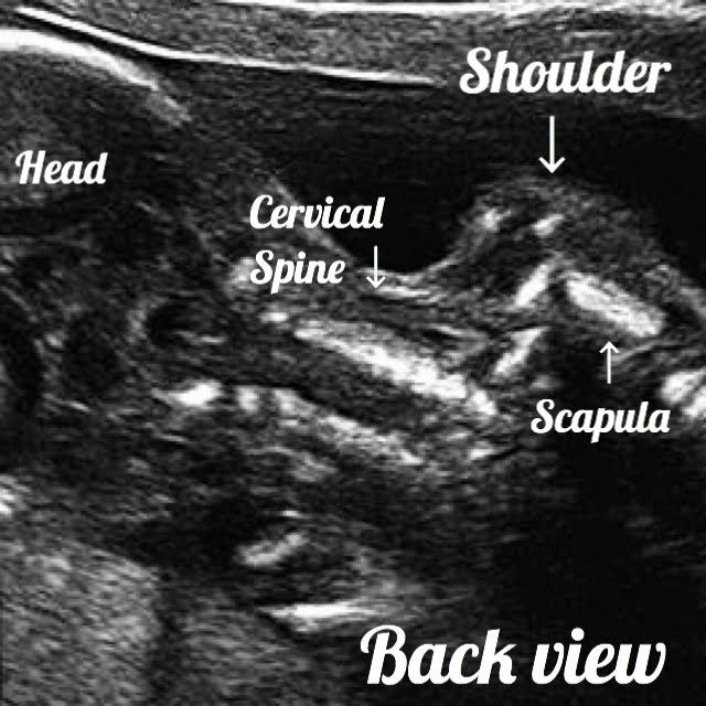 19 week Fetal pregnancy and ultrasound