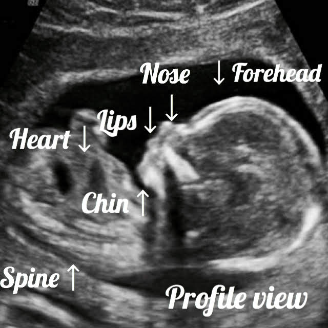 20 week fetal ultrasound