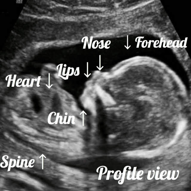 Normal 19 week baby ultrasound. - Ultrasoundfeminsider