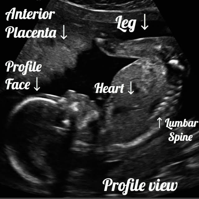 19 week Fetal pregnancy and ultrasound