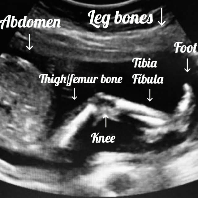 19 week Fetal pregnancy and ultrasound