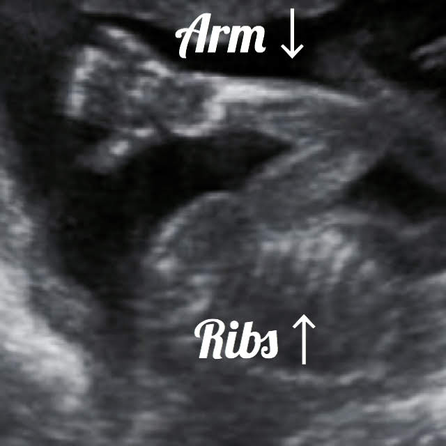 19 week Fetal pregnancy and ultrasound