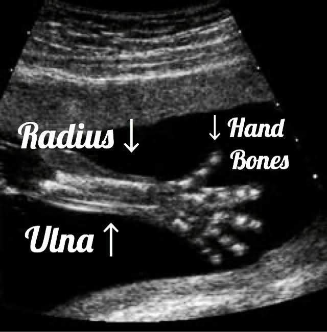 19 week Fetal pregnancy and ultrasound