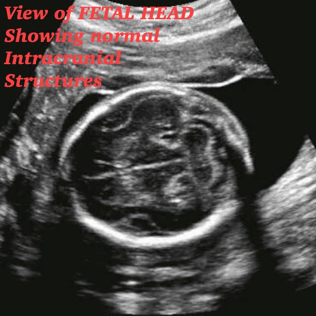 22 week pregnancy ultrasound