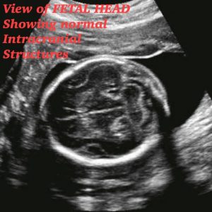 Normal 21 week baby ultrasound. - Ultrasoundfeminsider