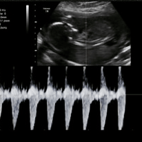 heart doppler at 23 week pregnancy ultrasound