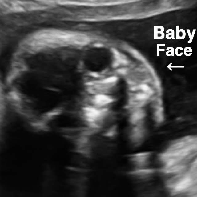 23 week pregnancy ultrasound