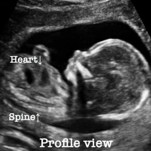 Normal 23 week baby ultrasound. - Ultrasoundfeminsider