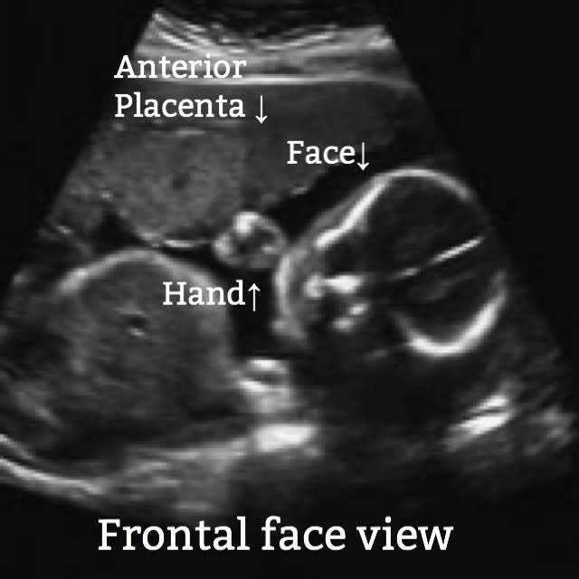frontal face view of a fetus on ultrasound