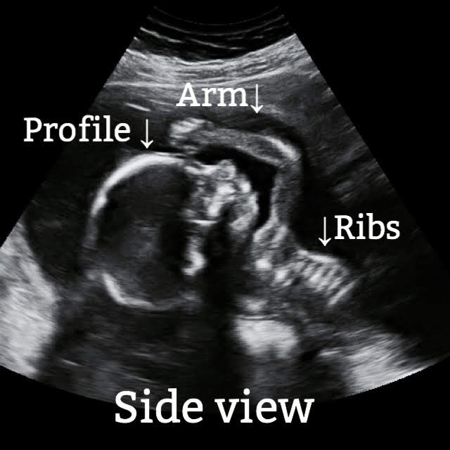 side view on ultrasound of a fetus