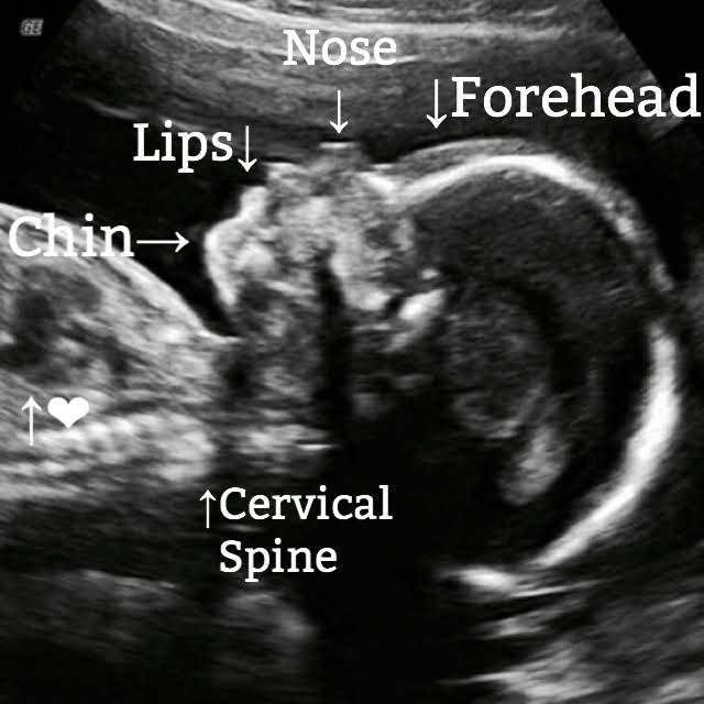 fetus seen on ultrasound