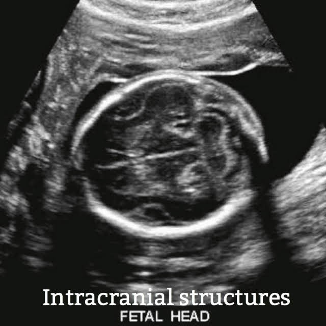 fetal head seen on ultrasound