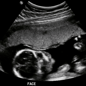 Normal 24 week baby ultrasound. - Ultrasoundfeminsider