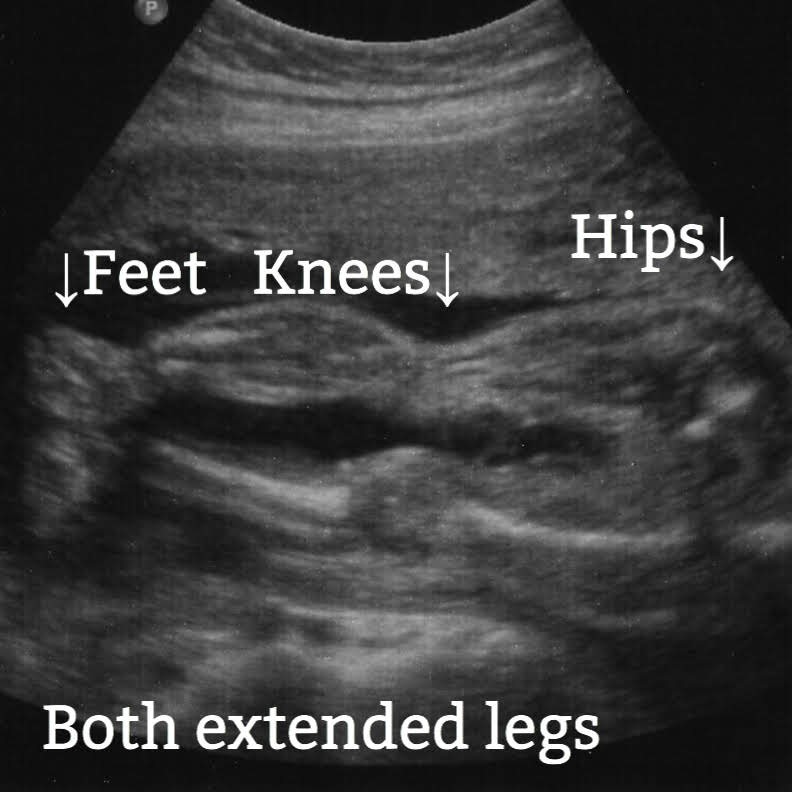 fetal legs seen on ultrasound