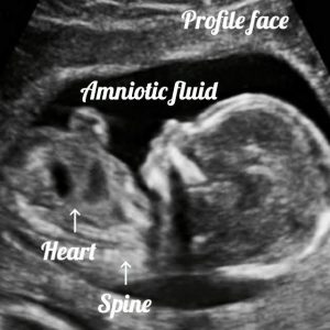 Normal 25 Week Baby Ultrasound. - Ultrasoundfeminsider