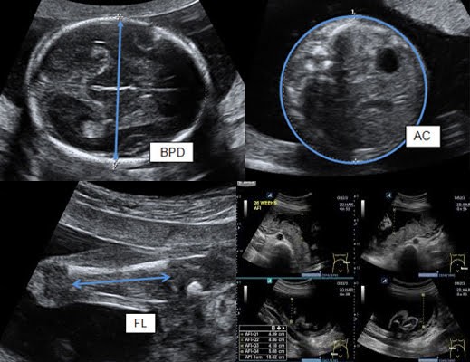 ultrasound image of a baby at 32 weeks, showing normal measuremets