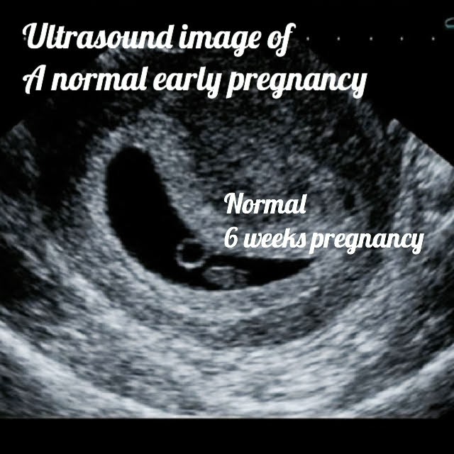 normal early pregnancy seen on ultrasound