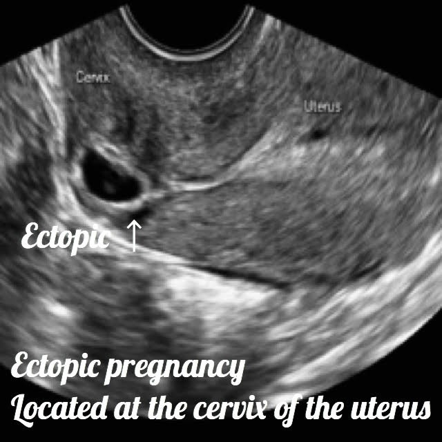 uterine ectopic pregnancy seen on ultrasound
