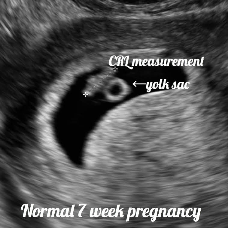 Ultrasound images of a normal 7 week baby pregnancy. 