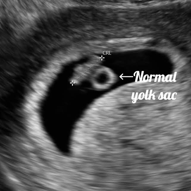 ultrasound image of a normal looking yolk sac, early gestation