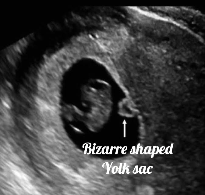 bizzarre shaped yolk sac