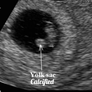 Normal first trimester 6 weeks ultrasound. - Ultrasoundfeminsider