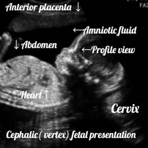 Normal 36 week baby ultrasound. - Ultrasoundfeminsider