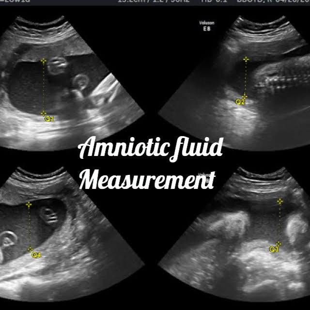 low amniotic fluid at 38 weeks